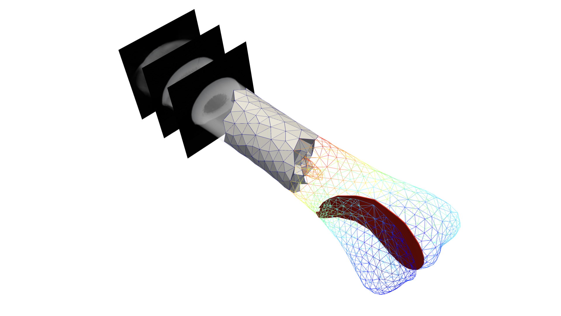 Bone Remodelling